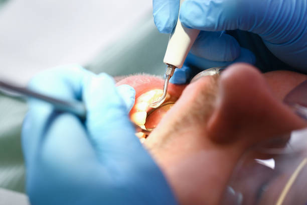 Best Emergency Tooth Extraction in Elton, LA